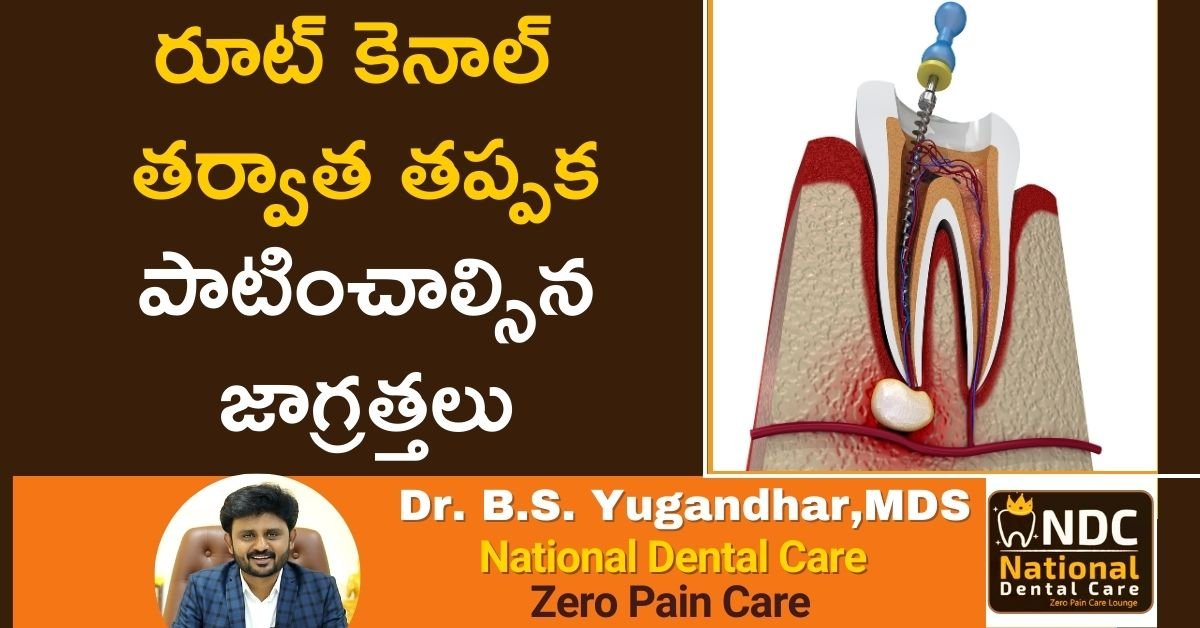 care after root canal